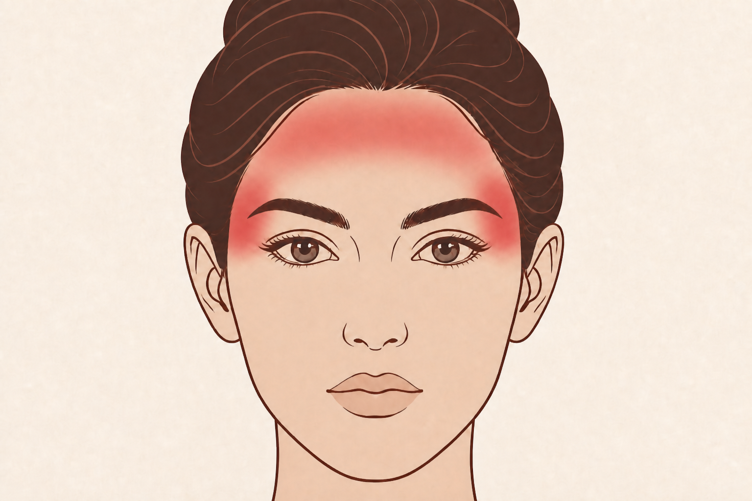 Illustratie van voorhoofd- en slaapzones bij botox voor migraine
